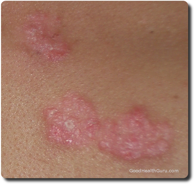 Image of Plaque Psoriasis