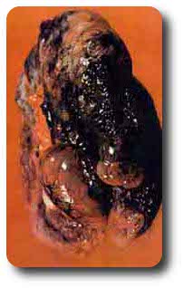 Image of a Lung Tumor